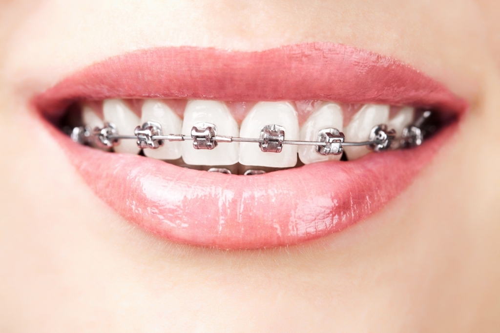 bigstock teeth with braces