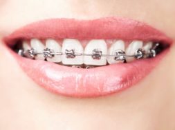 bigstock teeth with braces 40962418 1024x683