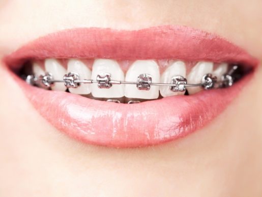 bigstock teeth with braces 40962418 1024x683